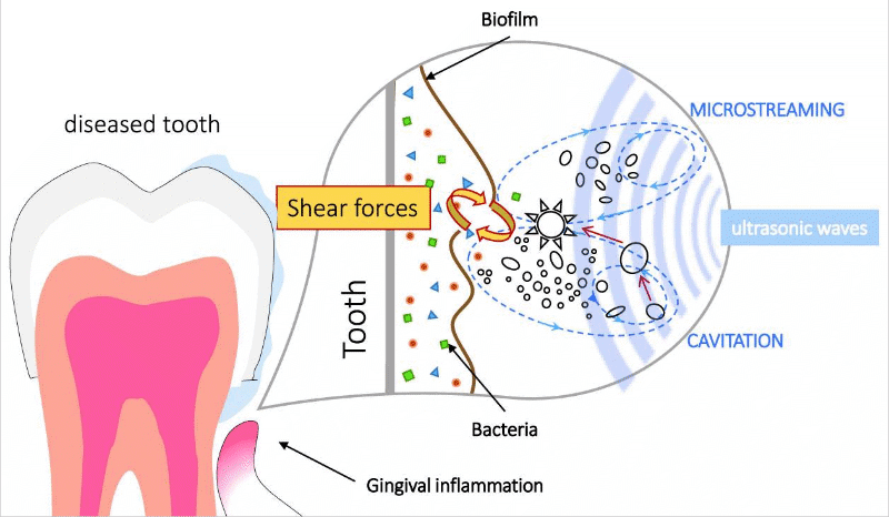 ultrasonic waves disrupting bacteria on the tooth surface optimised
