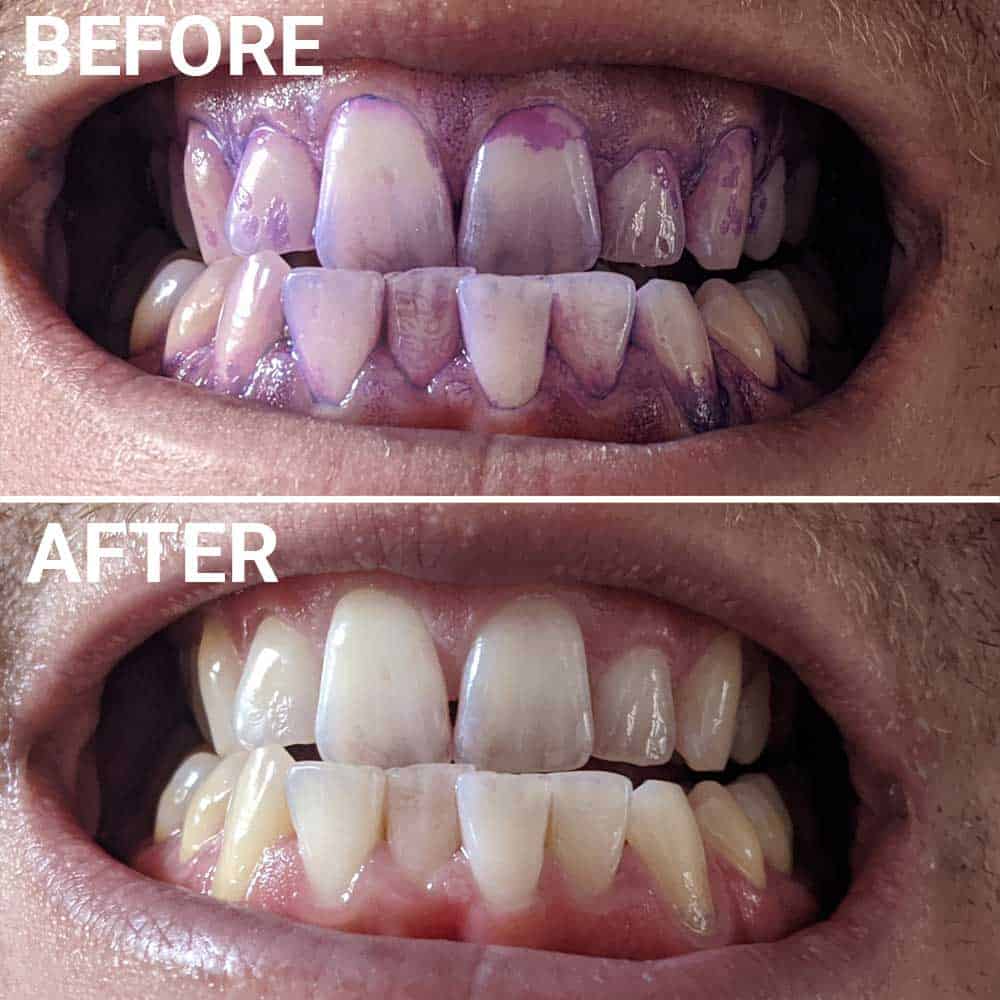 Plaque disclosing test with triple bristle